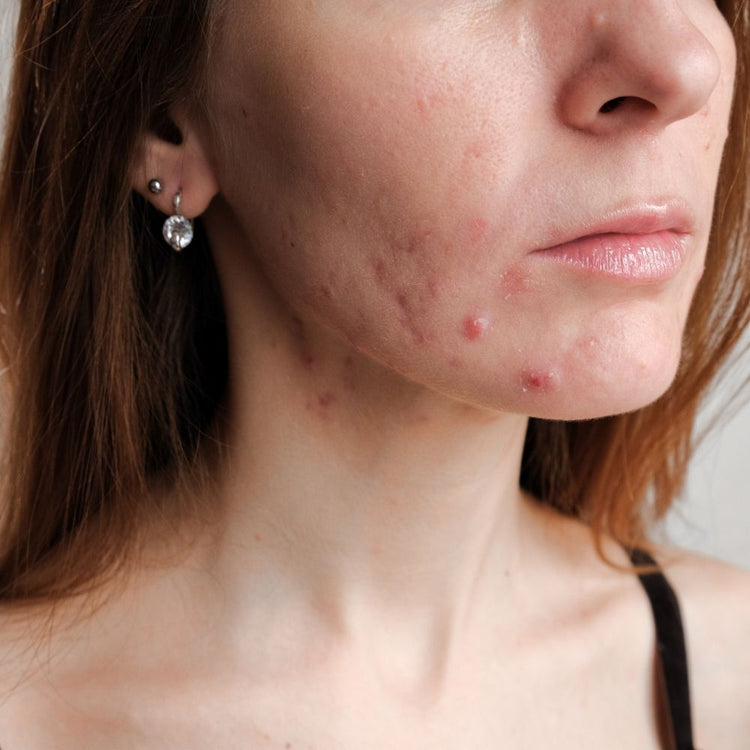 Unreine Haut & Akne
